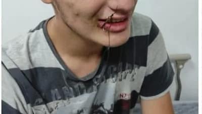 Bursa’nın Yenişehir ilçesinde ağzına balık oltası iğnesi takılan çocuk, itfaiye