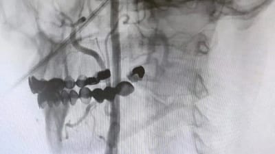 Manisa Şehir Hastanesi’nde karotis (şah) damarlarındaki tıkanıklıklara karşı ameliyatsız stent