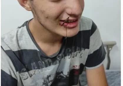 Bursa’da oltaya bu kez çocuk takıldı Bursa’nın Yenişehir ilçesinde ağzına balık oltası iğnesi takılan çocuk, itfaiye